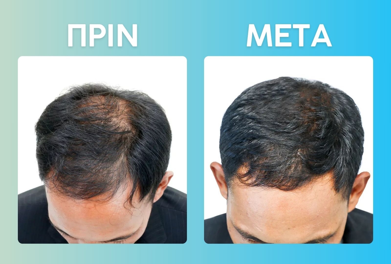 caduta shampoo before and after results of a mans hair