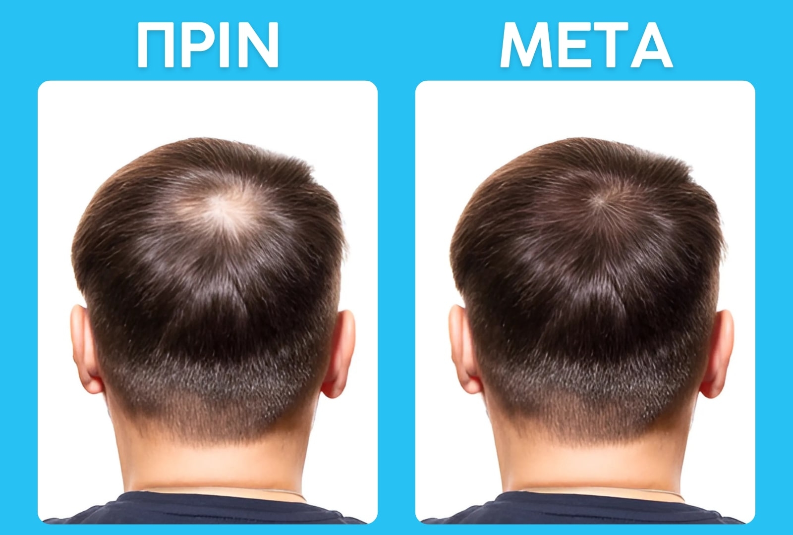 fair hair caduta shampoo before and after results of a mans hair